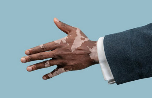 Vitiligo on hand