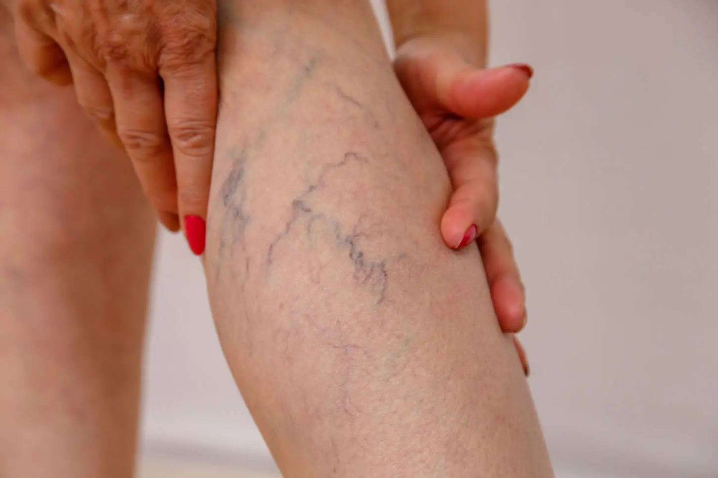 spider veins on legs